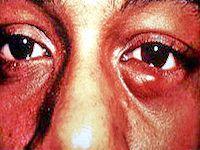 Ячмень на глазу — причины, симптомы, лечение, профилактика